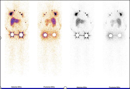 Lymphoedema after breast cancer treatment. The role of upper limb lympho-scintigraphy 10