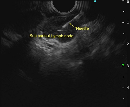 Mediastinal Lymph nodes Tuberculosis diagnosed by Endoscopic Ultrasound (EUS) guided biopsy 02