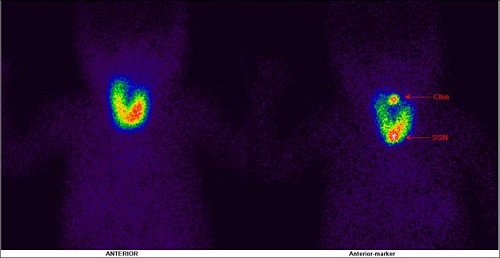 Osteitis Fibrosa Cystica of olecranon process of left ulnar bone, as Initial Manifestation of Primary Hyperparathyroidism” by Dr Shekar Shikare, HOD & Consultant, Nuclear Medicine, NMC Royal Hospital Sharjah