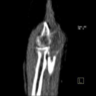 Osteitis Fibrosa Cystica of olecranon process of left ulnar bone, as Initial Manifestation of Primary Hyperparathyroidism” by Dr Shekar Shikare, HOD & Consultant, Nuclear Medicine