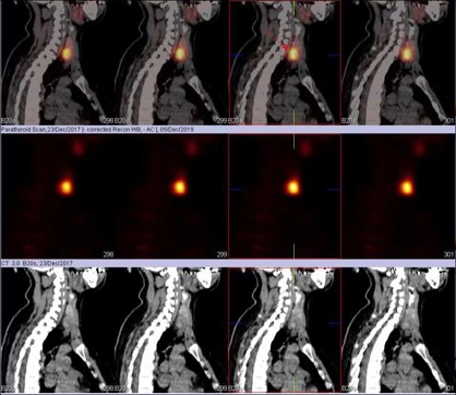 Osteitis Fibrosa Cystica of olecranon process of left ulnar bone, as Initial Manifestation of Primary Hyperparathyroidism” by Dr Shekar Shikare, HOD & Consultant, Nuclear Medicine