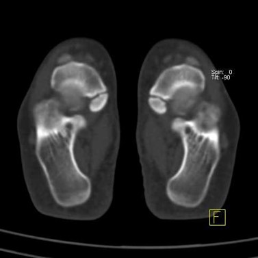 CASE OF THE WEEK – “Quiescent and Accessory Navicular Syndrome in the same patient” by Dr Shekhar Shikare, HOD & Consultant, Nuclear Medicine, NMC Royal Hospital Sharjah 01