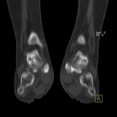 CASE OF THE WEEK – “Quiescent and Accessory Navicular Syndrome in the same patient” by Dr Shekhar Shikare, HOD & Consultant, Nuclear Medicine, NMC Royal Hospital Sharjah 02