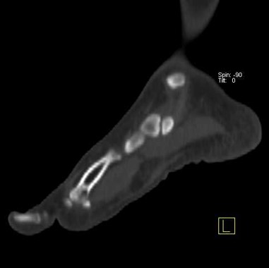 CASE OF THE WEEK – “Quiescent and Accessory Navicular Syndrome in the same patient” by Dr Shekhar Shikare, HOD & Consultant, Nuclear Medicine, NMC Royal Hospital Sharjah 04