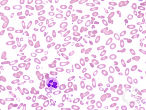 Rare challenging case of undiagnosed hereditary anaemia 02