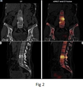 Role of Bone Scintigraphy in the early diagnosis of Discitis