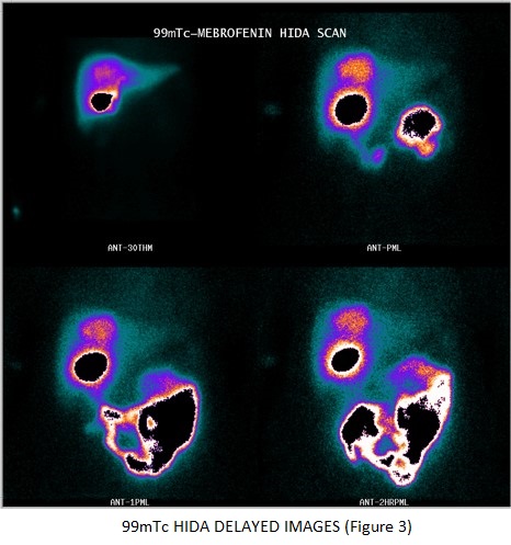 The Hot Spot Hepatbobilairy Scan in Focal Nodular Hyperplasia