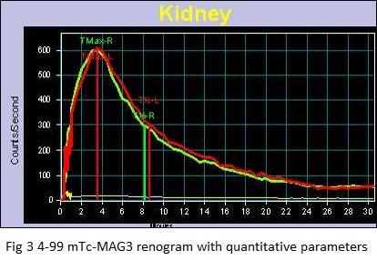 The Role of 99mtc DMSA Renal Scan in the Evaluation of Ectopic & Small Kidneys (Not Visualised on Ultrasonography) 04