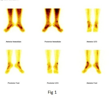 The role of hybrid bone SPECT/CT imaging in the work-up of the limping patient (Right fibular stress fracture at the syndesmosis level) 03
