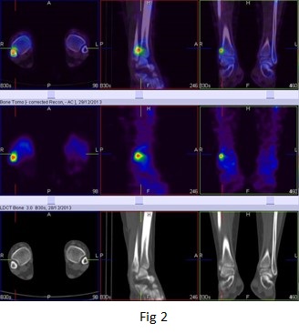 The role of hybrid bone SPECT/CT imaging in the work-up of the limping patient (Right fibular stress fracture at the syndesmosis level) 04