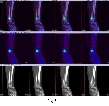 The role of hybrid bone SPECT/CT imaging in the work-up of the limping patient (Right fibular stress fracture at the syndesmosis level) 05