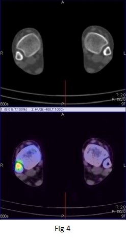 The role of hybrid bone SPECT/CT imaging in the work-up of the limping patient (Right fibular stress fracture at the syndesmosis level) 06