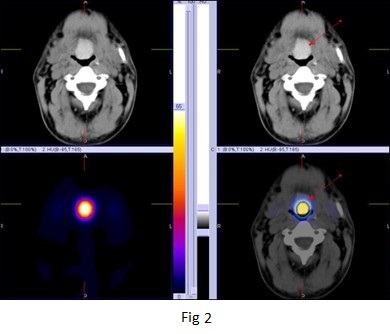 The role of hybrid bone SPECT/CT imaging in the work-up of the limping patient 02