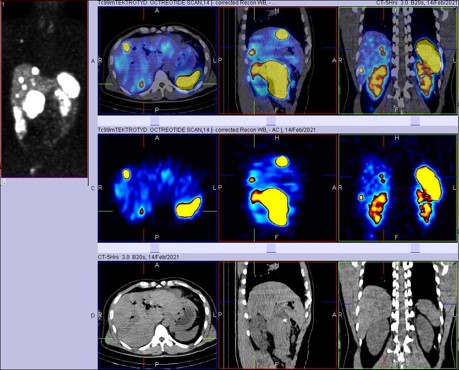 The value of whole body scintigraphy using (99M)Tc-HYNIC-TOC (Tektrotyd) and with single photon emission computerized tomography (SPECT/CT hybrid imaging) in the detection of primary and metastatic neuroendrocrine tumor (nets)