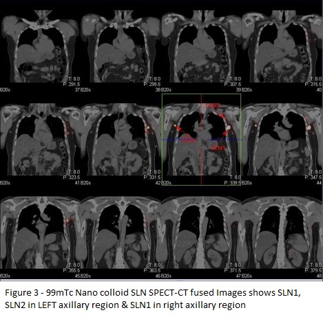 Use of Sentinel Node Lymphoscintigraphy in Malignant Melanoma 03