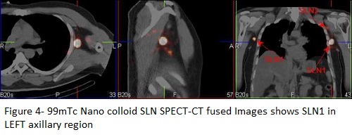 Use of Sentinel Node Lymphoscintigraphy in Malignant Melanoma 04