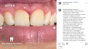 Dr Abeer Soliman, GP - Dentist, NMC Royal Hospital Sharjah gave insights on “Pyogenic Granulomas (PGs) in the oral cavity” in Instagram: