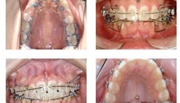 Micro-Implants in Orthodontic Treatment