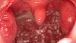 Tonsillectomy