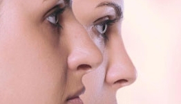 Nose Reshaping Female
