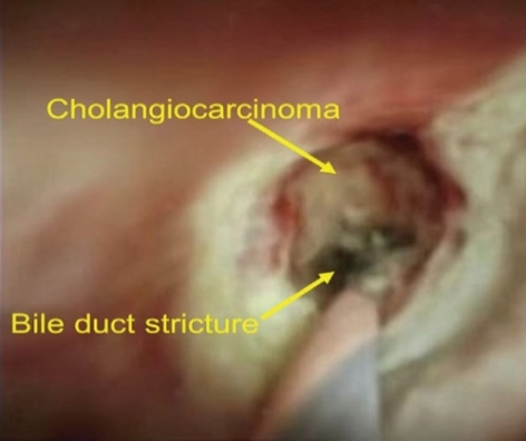 CASES OF THE WEEK – “First ever Cholangioscopy (Endoscopy inside the bile duct) at Al Zahra Hospital, Sharjah” by Dr Piyush Somani, Specialist Gastroenterology