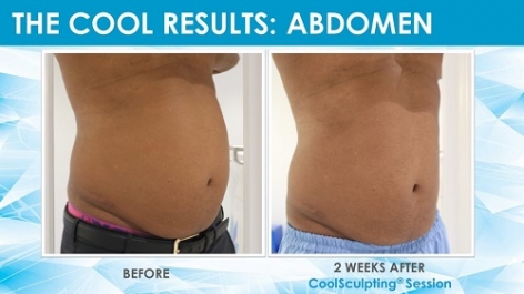 Before & After Results of CoolSculpting: Dr Ricardo Persaud, Consultant ENT Surgery, Al Zahra Hospital Sharjah