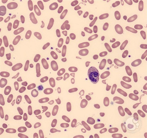CASES OF THE WEEK – “Rare challenging case of undiagnosed hereditary anaemia” by Dr Hossameldin Maged, Consultant Paediatrics, NMC Royal Hospital Sharjah