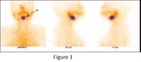CASES OF THE WEEK – “Thyroid Scintigraphy & Usefulness of Spect-ct Fused Imaging in Adult Hood with Missing Thyroid Gland” by Dr ShekharShikare, Consultant & HOD, Nuclear Medicine and Dr Ram Shukla, Specialist Infectious Diseases