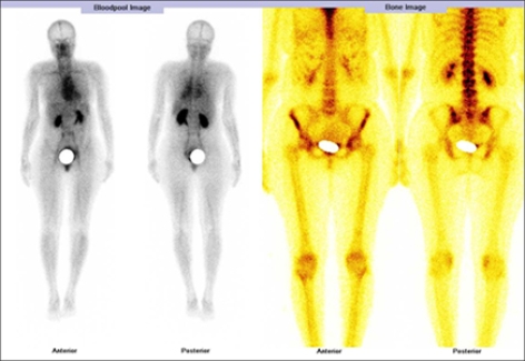 CASE OF THE WEEK – “The role of hybrid bone SPECT/CT imaging in the work-up of the painful hip & limping patient (more symptoms with less findings)”  by Dr. Shekhar Shikare, Consultant, Nuclear Medicine, Dr. Bobby Jose, HOD & Specialist, Neurosurgery & Clinical Administrator and Dr. Milind Raje, Consultant, Radiology at NMC Royal Hospital Sharjah