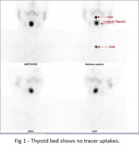 CASE OF THE WEEK – “The role of hybrid bone SPECT/CT imaging in the work-up of the limping patient (Right fibular stress fracture at the syndesmosis level).” by Dr Shekhar Shikare, HOD & Consultant, Nuclear Medicine, NMC Royal Hospital Sharjah (new case)