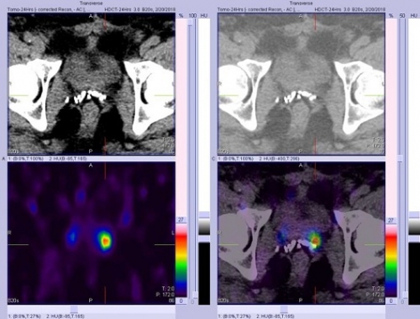 CASES OF THE WEEK - “ROLE OF 99mTc PSMA (Prostate specific membrane antigen) WHOLE BODY AND SPECT-CT SCAN in PROSTATE CANCER WITH PSA OF 0.454 ng/ml” by Dr ShekharShikare, Consultant & HOD, Nuclear Medicine, & Dr Mohammed Istrabadi, Consultant, Urology/General Surgery, NMC Royal Hospital Sharjah