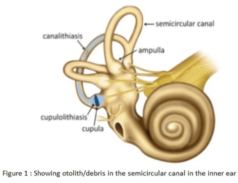 CASE OF THE WEEK- "Innovation of a new treatment strategy in treating persistent refractory positional vertigo using mastoid vibration device." by Dr. Shwan Mohamed- Consultant, ENT Surgeon at NMC Royal Hospital, Sharjah