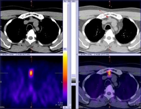 CASES OF THE WEEK - “Case of primary hyperparathyroidism due to an ectopic parathyroid adenoma presenting as acute pancreatitis” by Dr Shekhar Shikare, Consultant Nuclear Medicine & Dr Nishanth Sanalkumar, Consultant Endocrinology, NMC Royal Hospital Sharjah