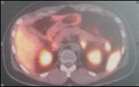 CASE OF THE WEEK – “Intrapancreatic true NET lesion in the tail of the pancreas VS splenunculi - The role of colloid liver spleen hybrid SPECT CT scintigraphy“ by Dr. Shekhar Shikare, HOD & Consultant, Nuclear Medicine & Dr. Akhilesh Sapra, Specialist, Gastrointestinal Surgeon, NMC Royal Hospital Sharjah