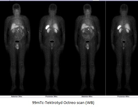 CASES OF THE WEEK – “Neuroendocrine Tumor Insulinoma On Somatostatin Receptor (Octreotide) Scintigraphy Associated With Men I” by Dr ShekharShikare, Consultant & HOD, Nuclear Medicine