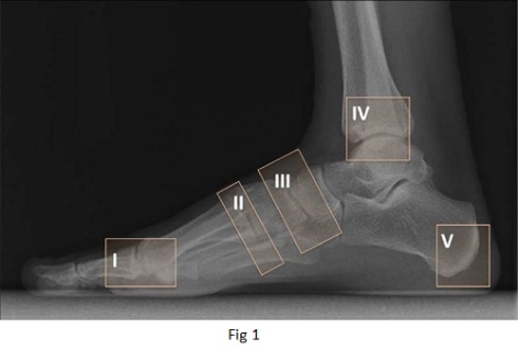CASE OF THE WEEK – “A case of bilateral charcot joints of foot (right >>left) with right mid foot ulceration and planter surface soft tissue inflammation.” by Dr Shekhar Shikare, HOD & Consultant, Nuclear Medicine, NMC Royal Hospital Sharjah