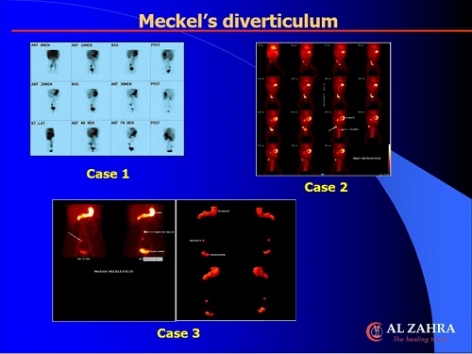 CASES OF THE WEEK - “Bleeding Meckles Diverticulum (Three Short Cases)” by Dr Shekhar Shikare, Consultant & HOD, Nuclear Medicine, NMC Royal Hospital Sharjah