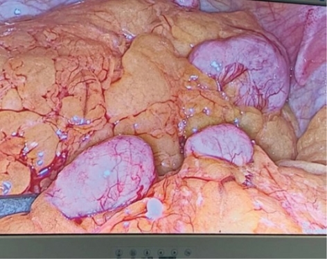 CASES OF THE WEEK – “A rare case of eradication of parasitic fibroids in Al Zahra Hospital Sharjah” by Dr Mohamed Hasoun, Specialist Obstetrics & Gynaecology