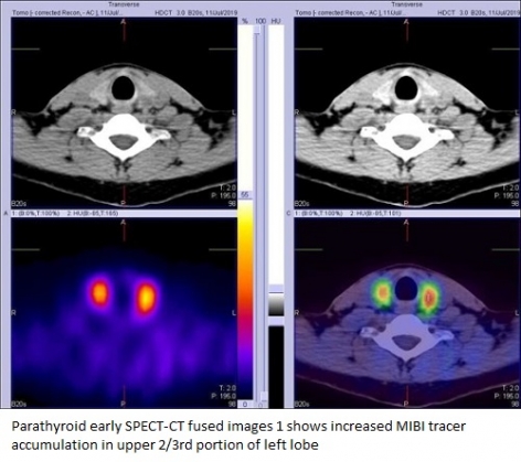 CASES OF THE WEEK – “The role of 99mtc-sestamibi in the evaluation of thyroid nodule & its diagnostic accuracy (unusual cases picked up on dual isotope technique 99mtc- Sestamibi Parathyroid & 99mtco4 Thyroid Scintigraphy) with Diagnosis of Hyperparathyroidism” by Dr ShekharShikare, Consultant & HOD, Nuclear Medicine