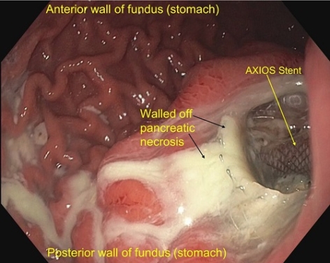 CASES OF THE WEEK – “Endoscopic necrosectomy of large walled off pancreatic necrosis (pseudocyst with solid necrosis)” by Dr Piyush Somani, Specialist Gastroenterology, Al Zahra Hospital Sharjah