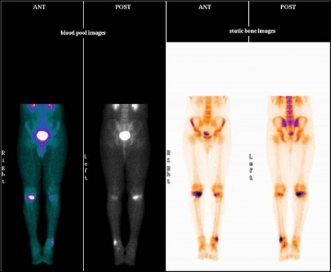 CASES OF THE WEEK - “Nuclear Medicine In Sports & Usefulness Of Hybrid Bone Spect-Ct Imaging” by Dr ShekharShikare, Consultant & HOD, Nuclear Medicine, NMC Royal Hospital Sharjah